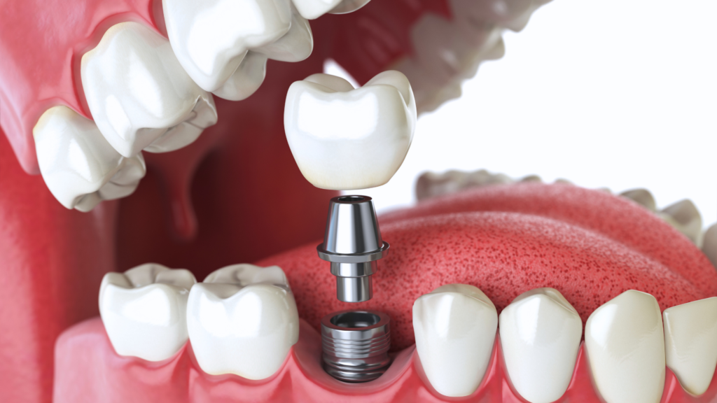 Dental implant with abutment and crown being placed in a patient’s mouth at Professional Dental clinic in Utah.